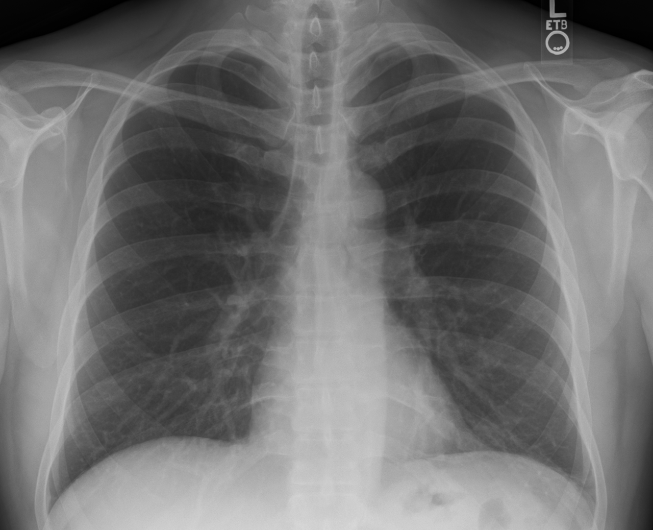 Posteroanterior chest radiograph, grayscale, open in a diagnostic viewer